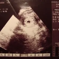 Jak wygląda dziecko w 5 tyg ciąży? Zaskakujący rozwój zarodka